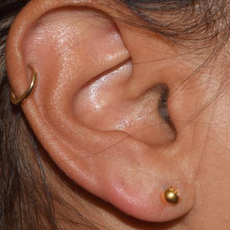 After image 2 Case #106226 - In Office Bilateral Earlobe Repair Procedure