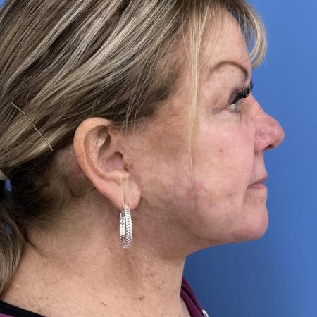 After image 3 Case #117311 - 64 year old-Facelift/Blepharoplasty