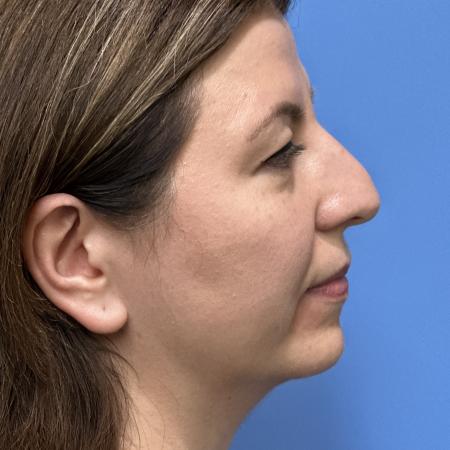 Before image 3 Case #117461 - 43 year old  -  Open Rhinoplasty  -  3 months post