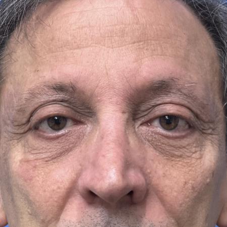 Before Case #117381 - 63 year old - Upper & Lower Bleph