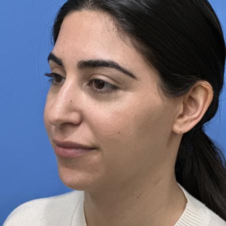 Before image 2 Case #117306 - 30 year old - Open Rhinoplasty