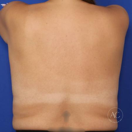 After image 5 Case #118451 - Augmentation Mastopexy with Inverted Nipple Repair