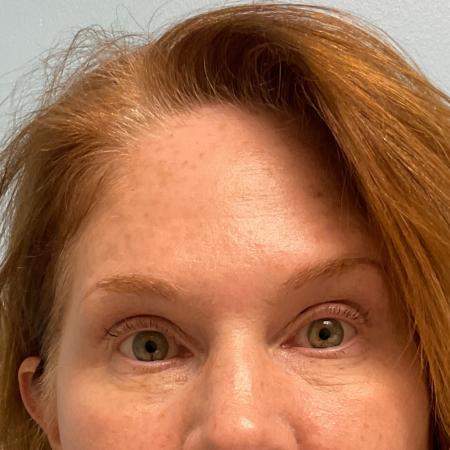 After image 2 Case #119701 - Botox Injections