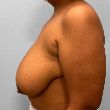 Before image 3 Case #120916 - Breast Reduction