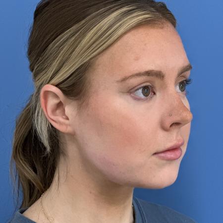 After image 2 Case #125036 - LipoRF to the Neck