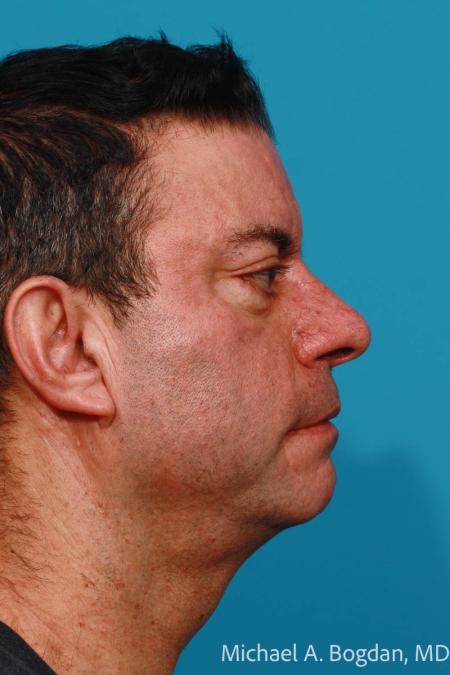 Before image 3 Case #111806 - Brow Lift and Blepharoplasty