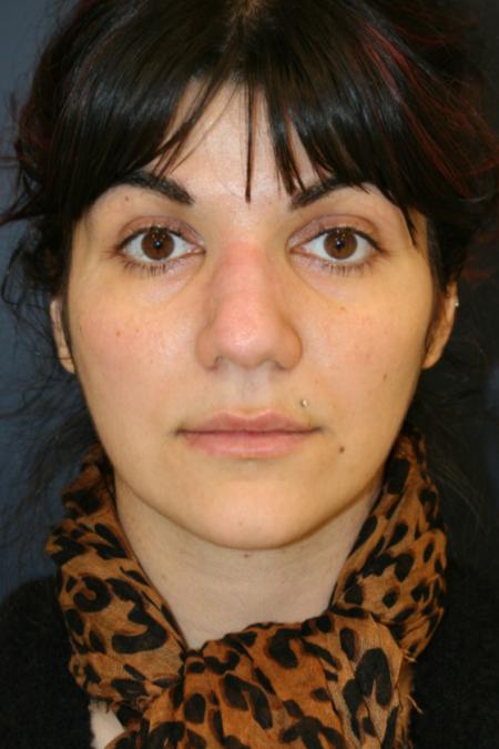 Before image 1 Case #121896 - Female Rhinoplasty
