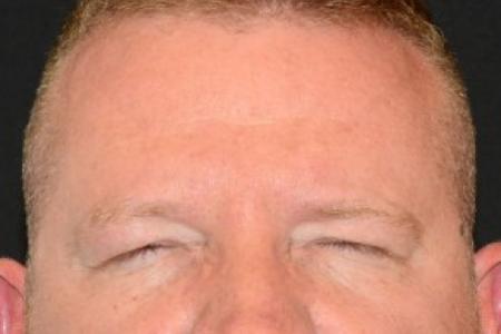 After Case #86391 - 40 year old man treated with Botulinum Toxin