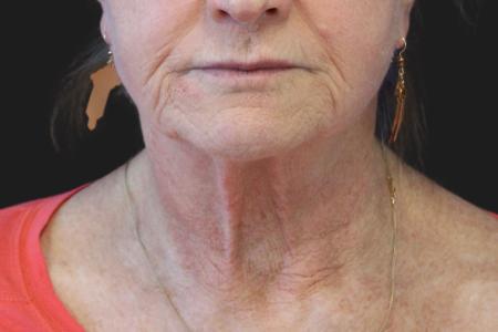 Before image 1 Case #111861 - 70 year-old facial rejuvenation
