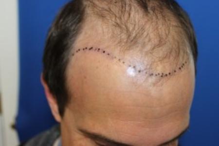 Before Case #87396 - Hair Transplantation San Diego
